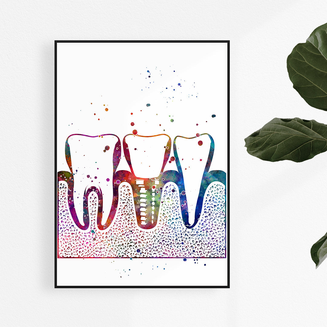 Dental Implant Art Print – Colorful Tooth Wall Decor