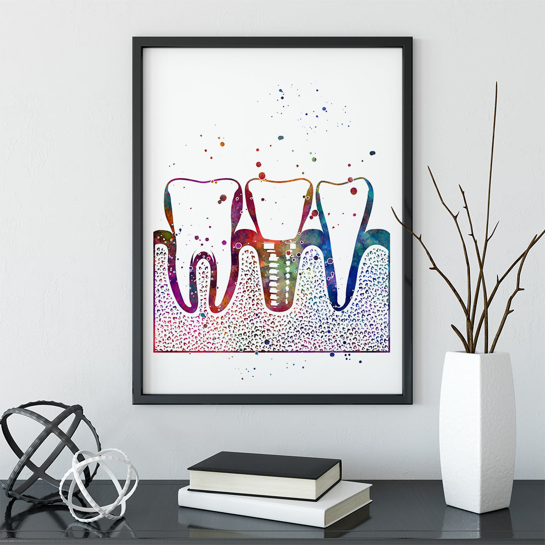 Dental Implant Art Print – Colorful Tooth Wall Decor