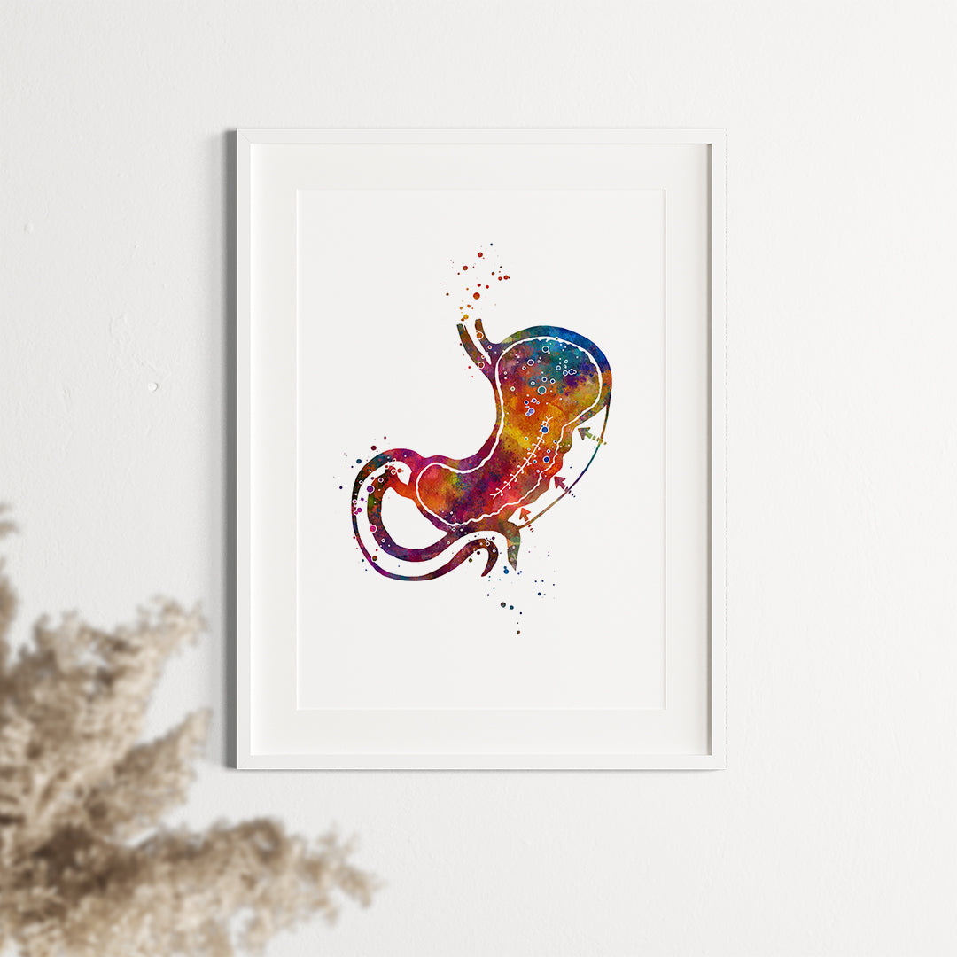 Endoscopic Sleeve Gastroplasty Colorful Watercolor Print