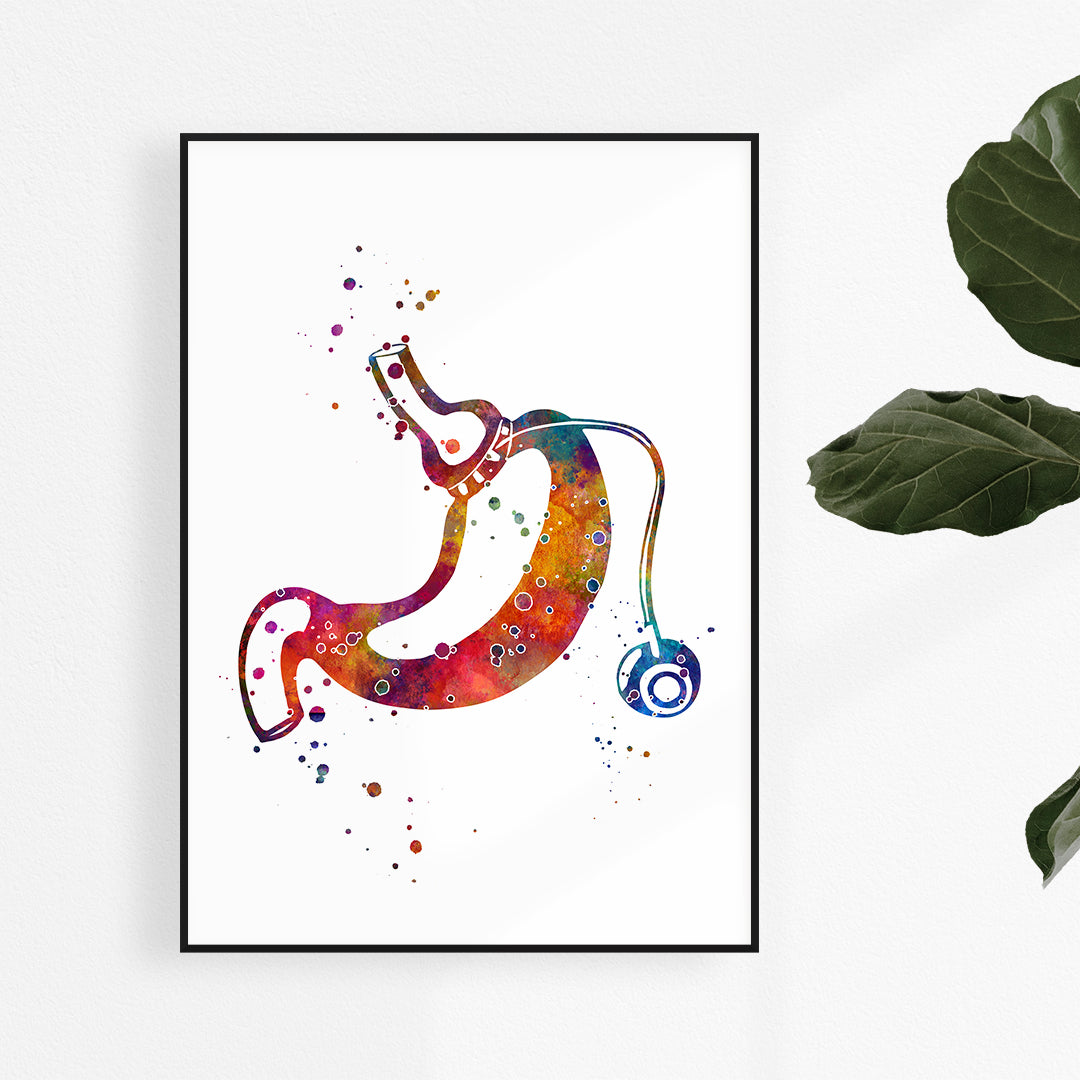 Gastric Banding watercolor print, ideal for weight-loss surgery office decor.