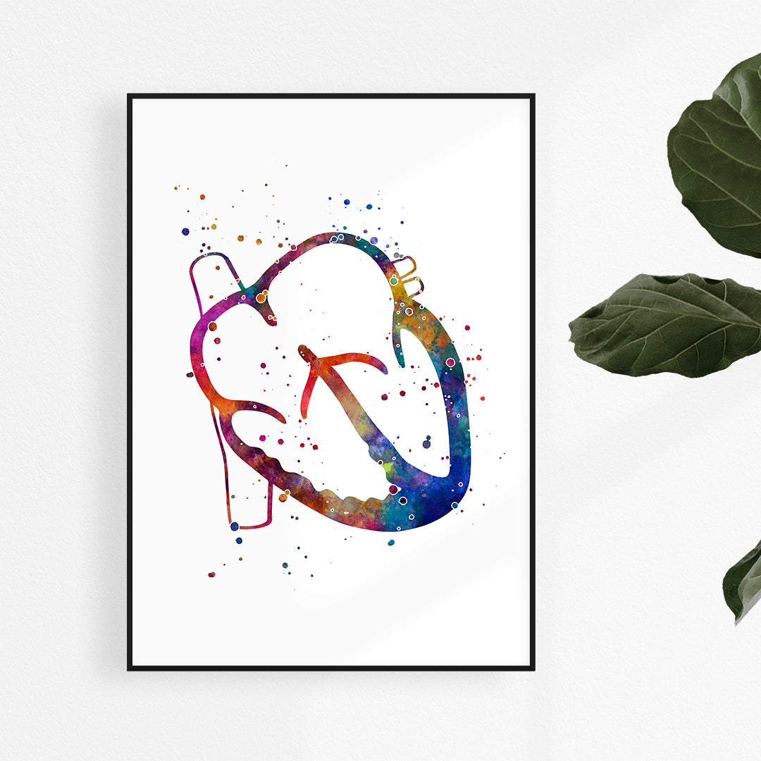 ASD Congenital Heart Defect watercolor art print for medical decor.