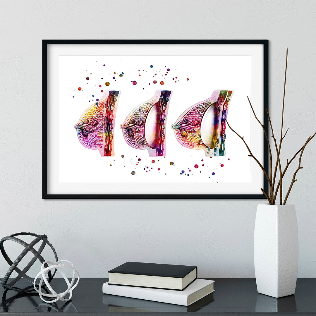 Female Breast Augmentation Watercolor Print