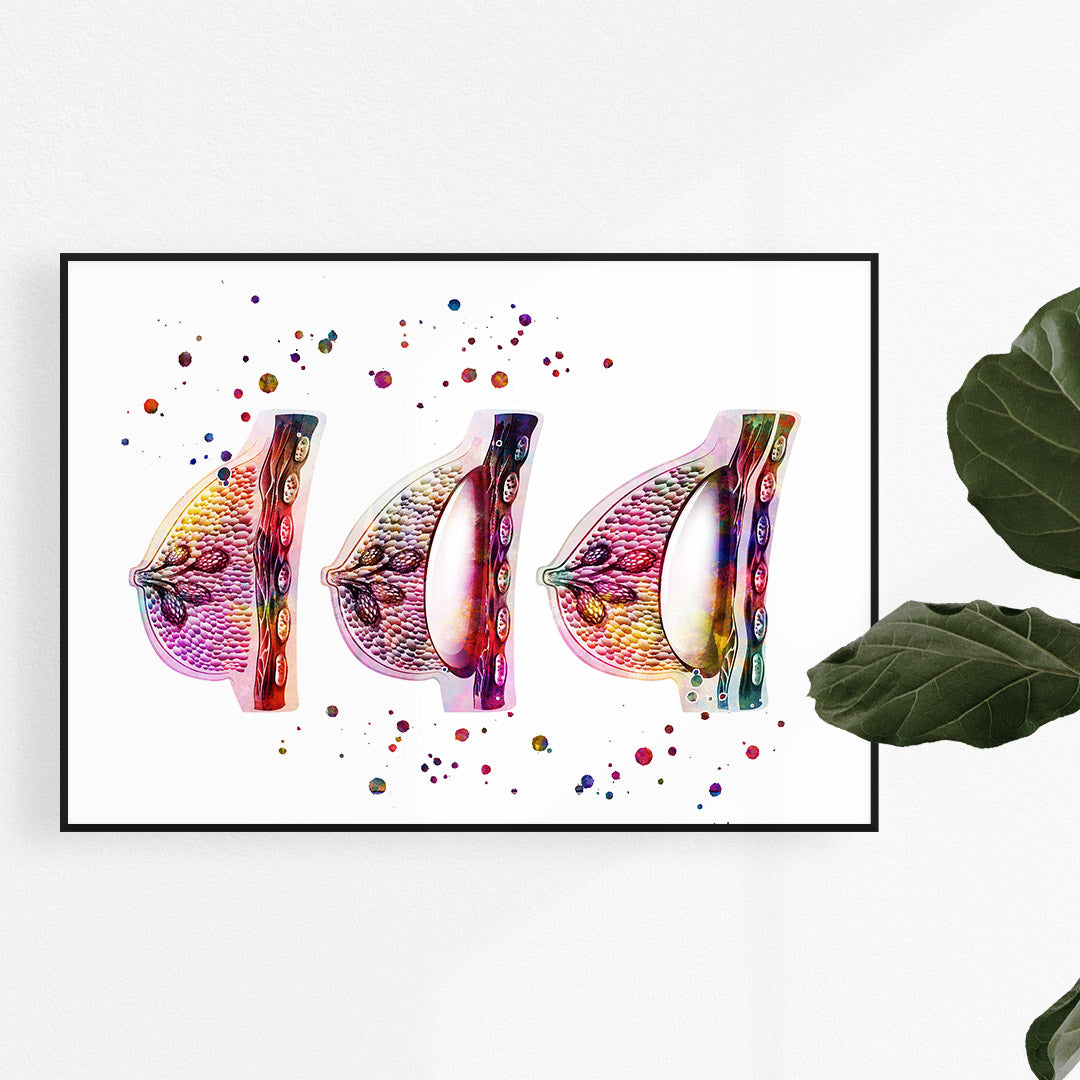 Female Breast Augmentation Watercolor Print