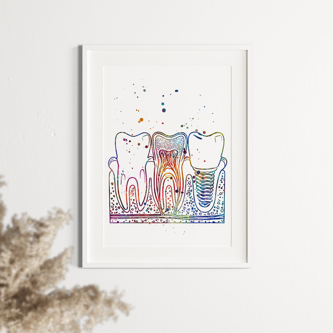 Artistic watercolor print featuring teeth and implant for modern dental decor