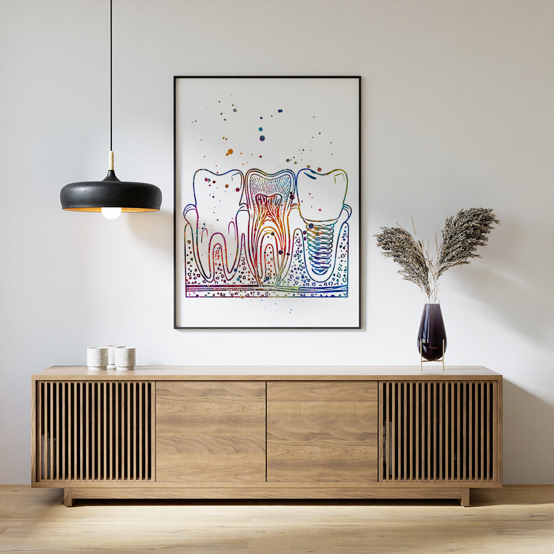 Dental Implant Art Print for Dentist Office Decor