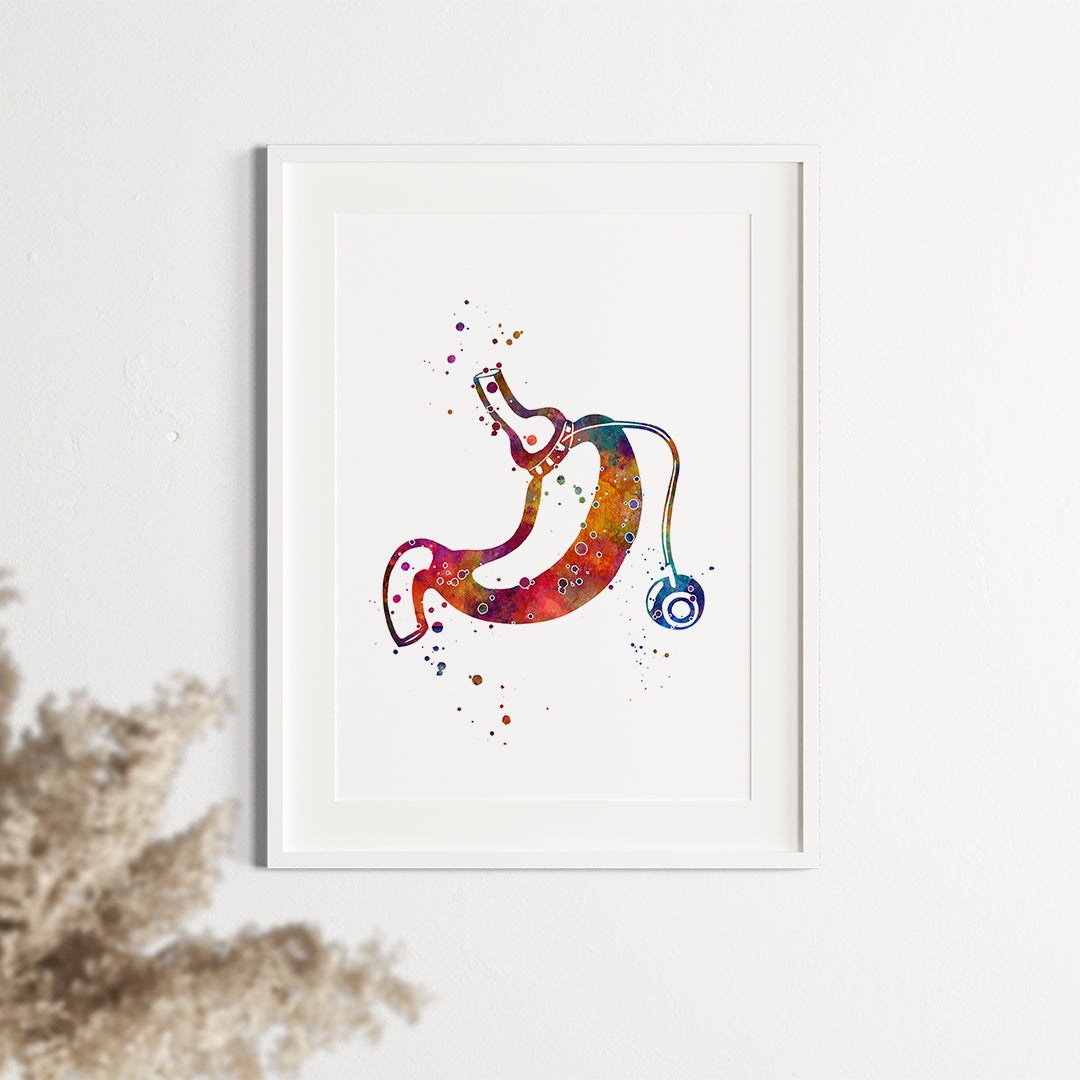 Gastric Band Bariatric Surgery Art Watercolor Print