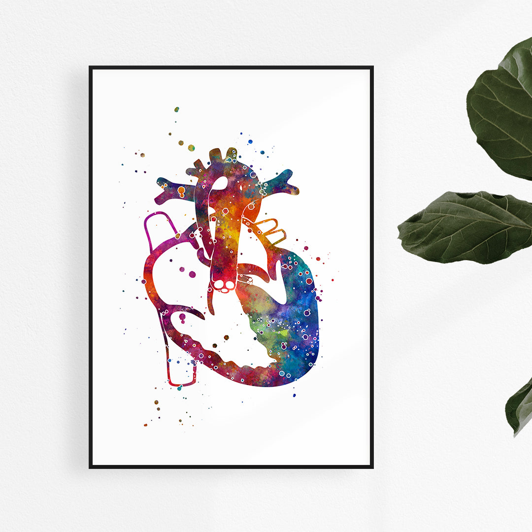 Hypoplastic Left Heart Syndrome Colorful Watercolor Print for pediatric clinic decor