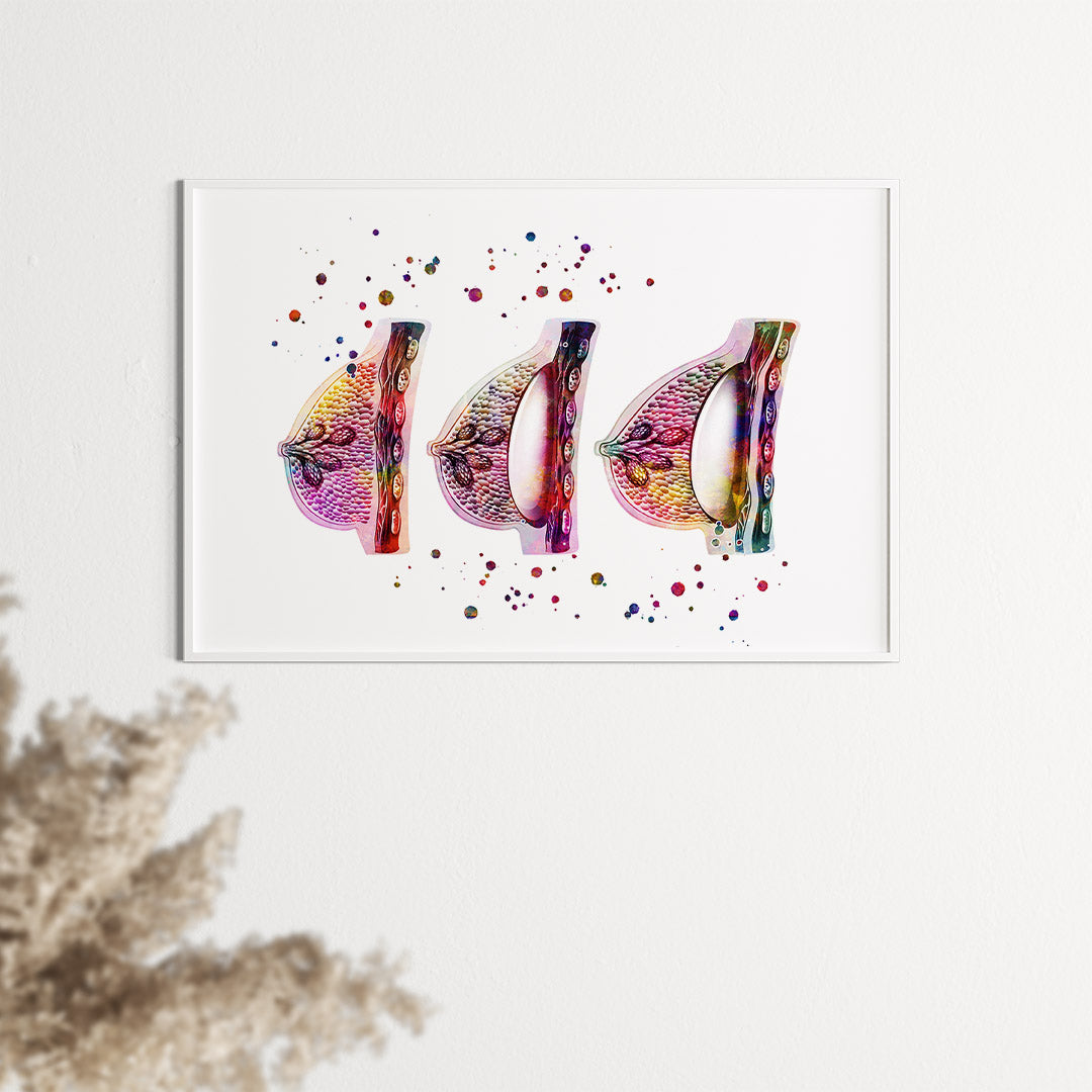 Female Breast Augmentation Watercolor Print
