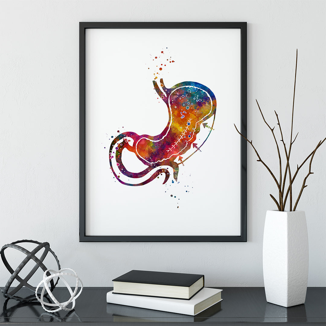 Endoscopic Sleeve Gastroplasty Colorful Watercolor Print