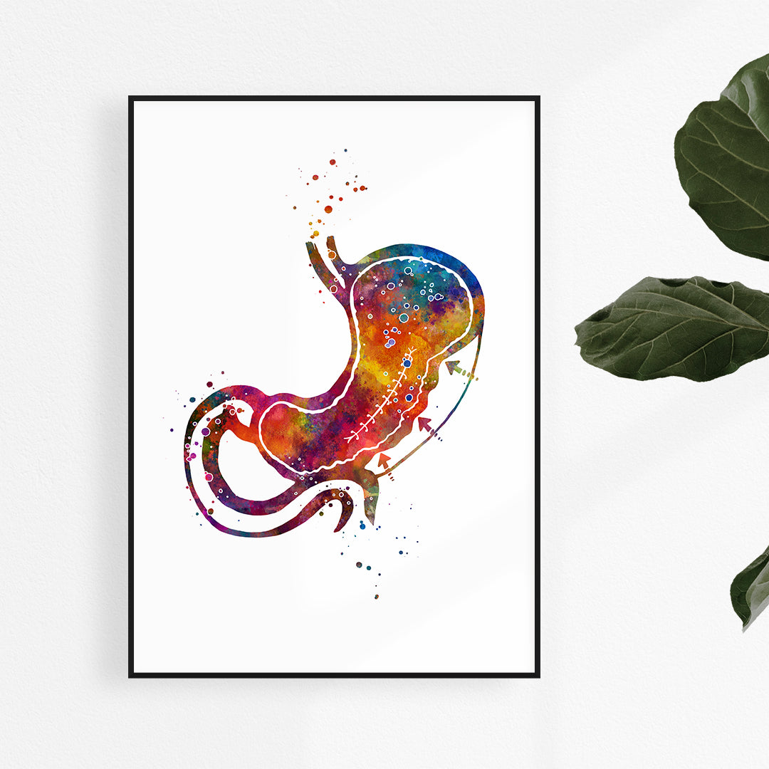 Endoscopic Sleeve Gastroplasty Colorful Watercolor Print